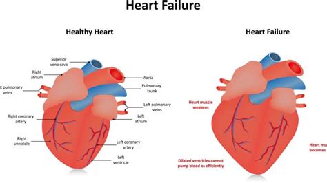 mild global hypokinesis of lv|global hypokinesis meaning.